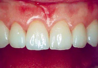 Porcelain Veneers