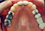 Tooth Colored Fillings